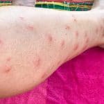 Sandfliegen Bilder (sand flies): Wie man sich vorbeugend gegen Bisse schützen kann und was hilft gegen den Juckreiz.