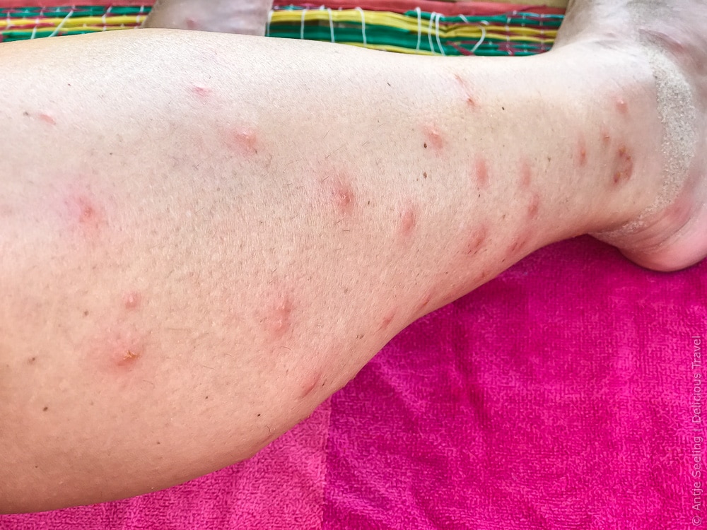 Sandfliegen Bilder (sand flies): Wie man sich vorbeugend gegen Bisse schützen kann und was hilft gegen den Juckreiz.